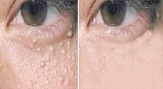 สิวข้าวสาร หรือสิวหิน Milia ดูแลได้อย่างไร ? สิวข้าวสาร หรือสิวหิน Milia ดูแลได้อย่างไร ?